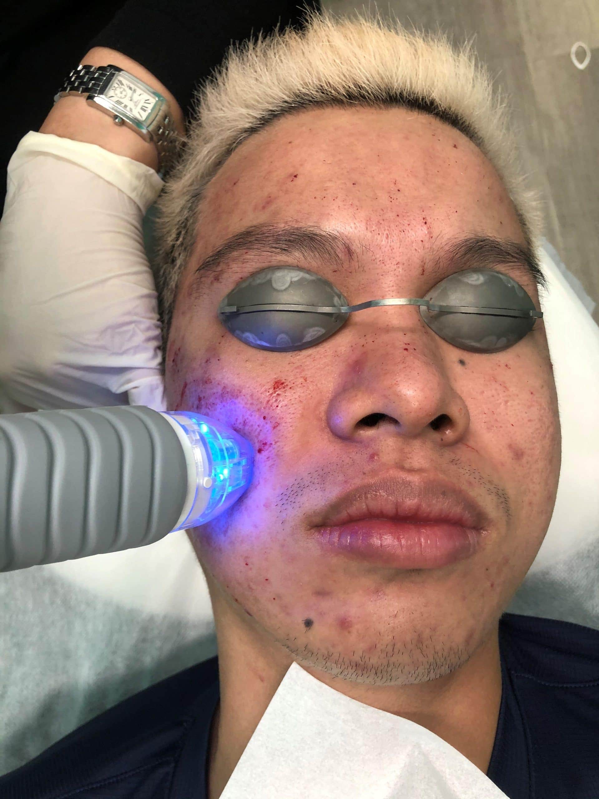 Blackheads Congestion City Laser Clinic Sydney