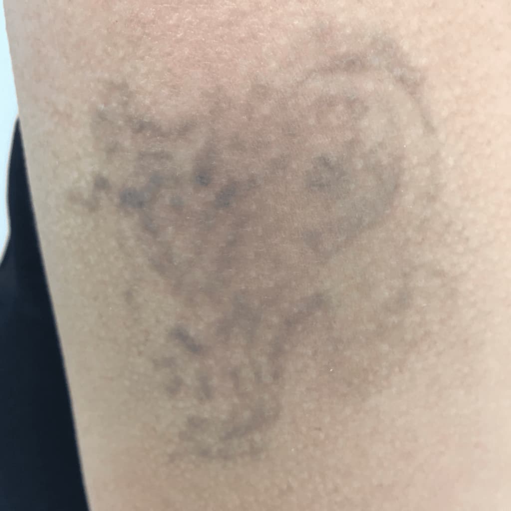 Tattoo Removal | City Laser Clinic Sydney
