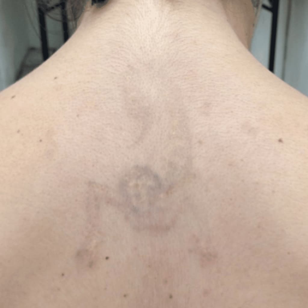 Tattoo Removal | City Laser Clinic Sydney