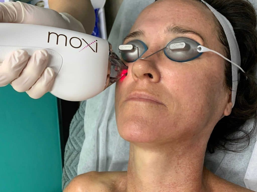 Moxi Laser Treatment